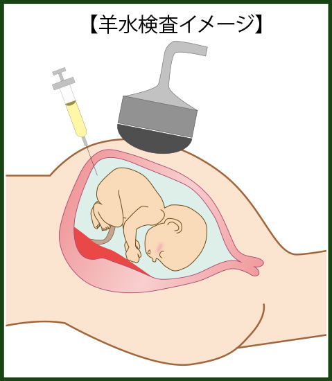 羊水検査イメージ