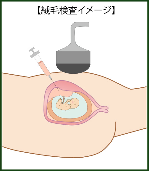 絨毛検査イメージ